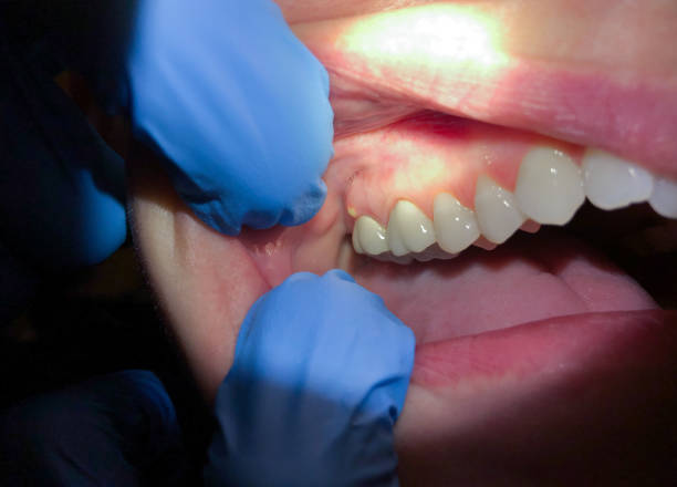 Urgent Tooth Repair in GA